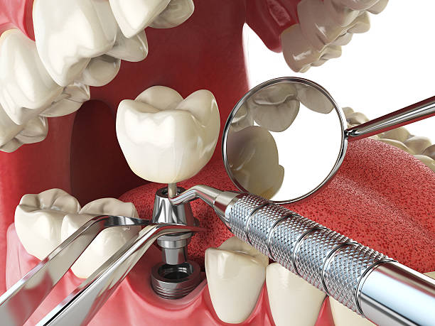 Best Emergency Tooth Extraction in Lexington, TN